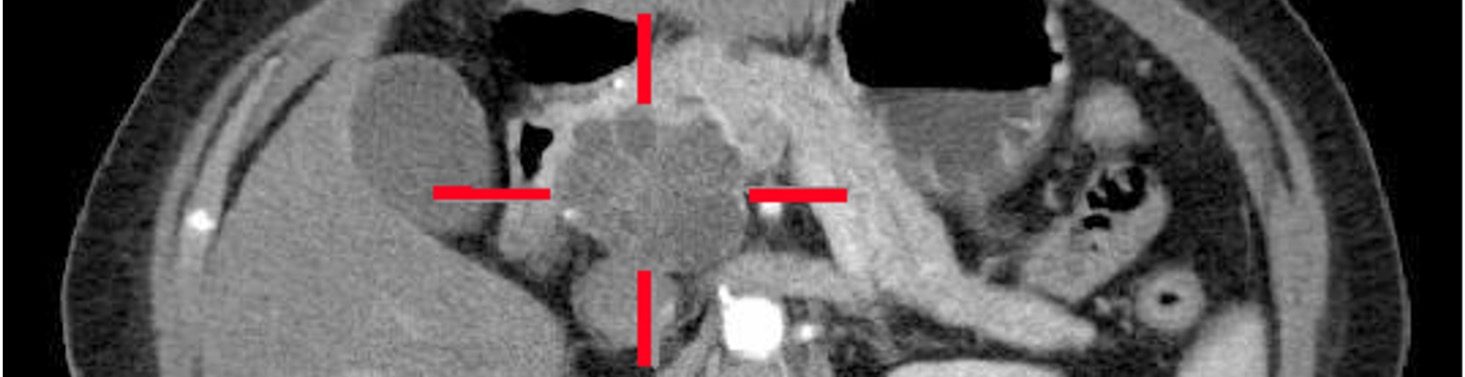Outcome4PancreaticCancer